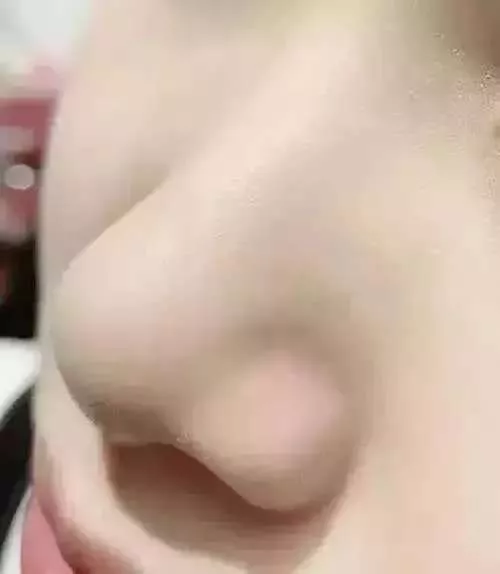 Gel Mụn Klena 0,1 và 0,3 hỗ trợ mụn ẩn, mụn đầu đen mụn trứng cá và ngừa mụn