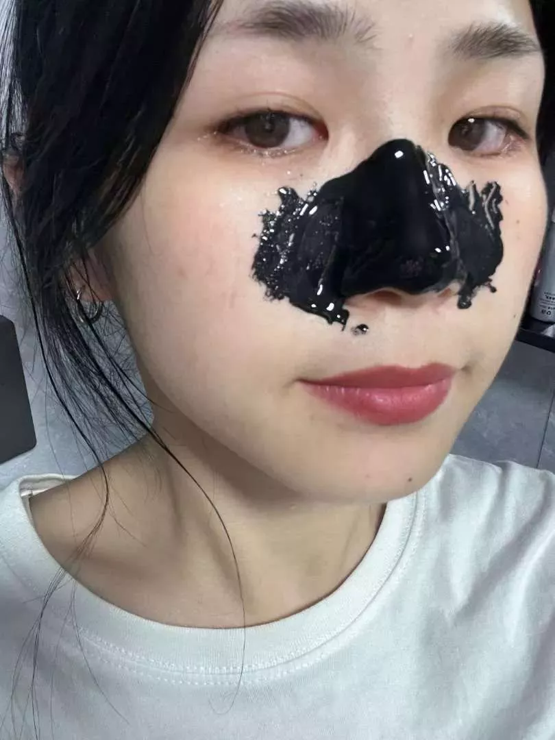Gel Mụn Klena 0,1 và 0,3 hỗ trợ mụn ẩn, mụn đầu đen mụn trứng cá và ngừa mụn
